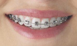 self-ligating braces